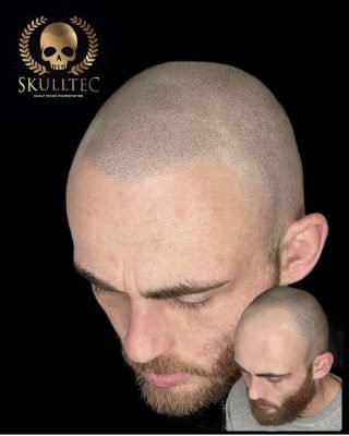Tattoos - The Remedy For Baldness - StyleFrizz