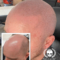 How Can You Achieve the Best Results with Scalp Micropigmentation for Your Hairline?